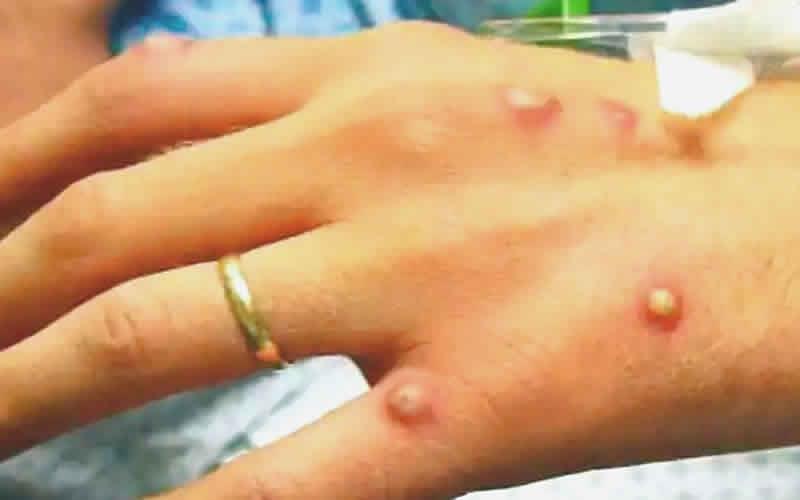 СЗО: 780 случаи на мајмунски сипаници во 27 држави, бројот сигурно е поголем