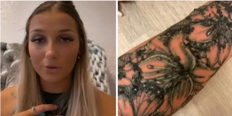 Совршена тетоважа се претворила во „пекол“ поради алергиска реакција на мастило!