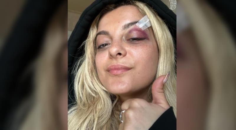 Бебе Раџа покажа како изгледа, откако среде концерт во Њујорк ја погодија со мобилен (ВИДЕО)