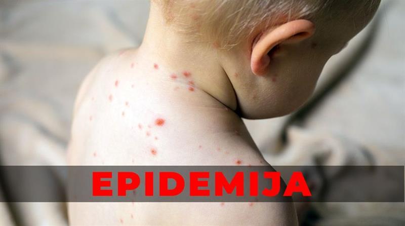 Во Белград е прогласена епидемија на мали сипаници