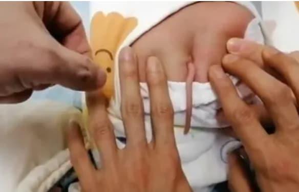 Бебе се родило со опашка, долга 10 сантиметри- докторите имаат објаснување (ВИДЕО)