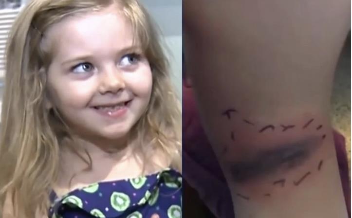  Забележала огромна модринка на телото кај своето дете