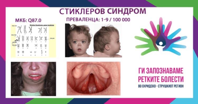 „Ги запознаваме ретките болести“ - Стиклеров синдром