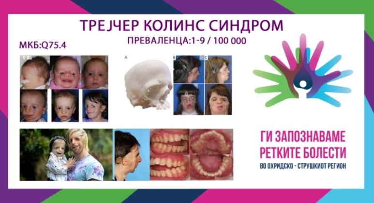 „Ги запознаваме ретките болести“ - Трејчер Колинс синдром (ТКС)