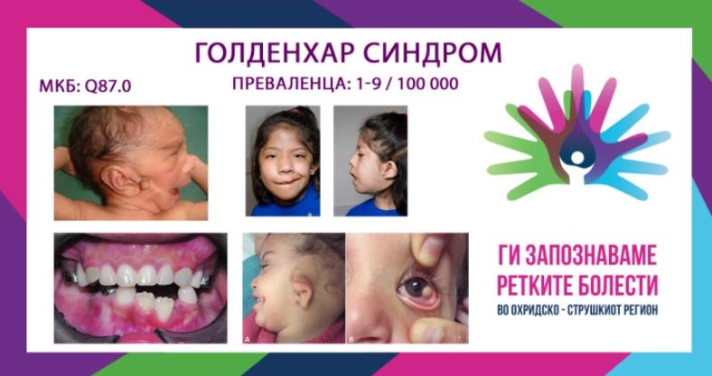 „Ги запознаваме ретките болести“ - Голденхар синдром
