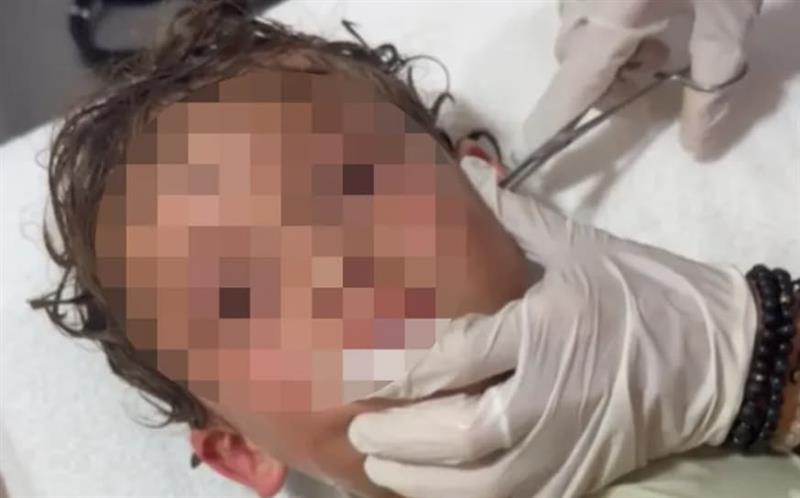Кошмар за секој родител: Докторите вадат жив рак од уво на мало дете (ВИДЕО)