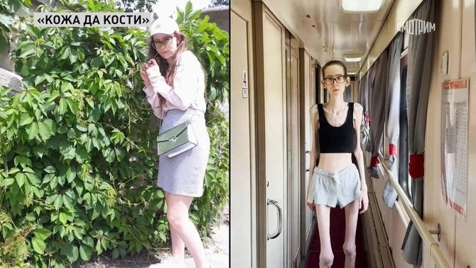 Aнастасија има само 29 килограми на 176 см висина: „Бев еднаш заљубена, но не смеев да признаам“