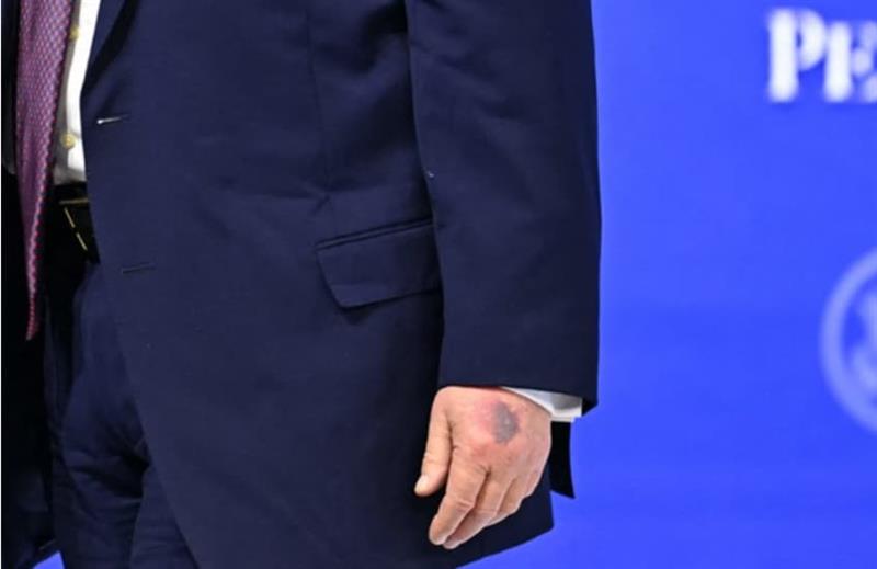Трамп се појави во Давос со нова модрица на раката 