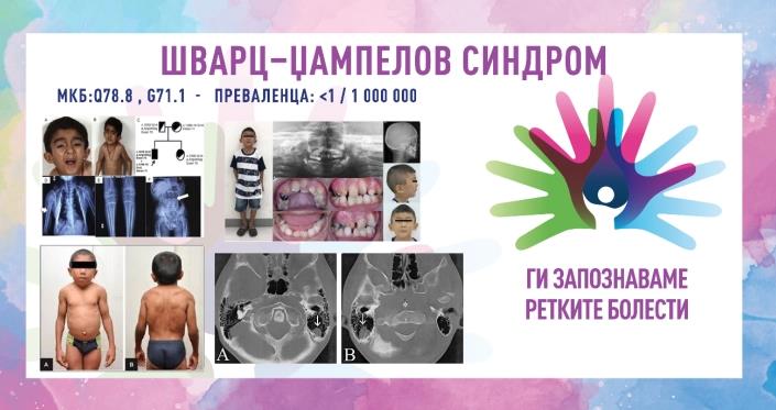 „Ги запознаваме ретките болести“: Шварц-џампелов синдром/Хондродистрофична миотонија/SCHWARTZ–JAMPEL SYNDROME