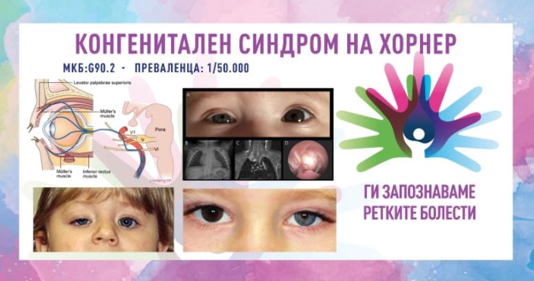„Ги запознаваме ретките болести“: Конгенитален синдром на Хорнер