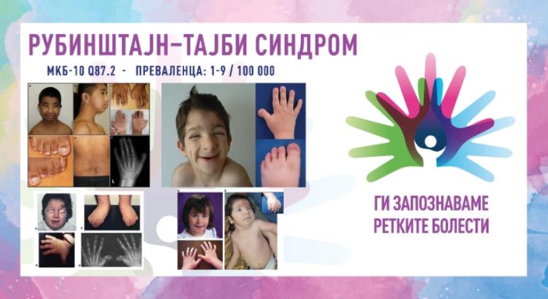 „Ги запознаваме ретките болести“: Рубинштајн–Тајби синдром