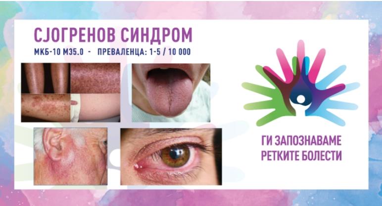 „Ги запознаваме ретките болести“: Сјогренов синдром
