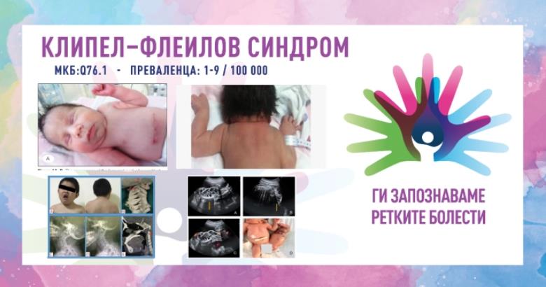 „Ги запознаваме ретките болести“: Клипел-Флеилов синдром/Синдром на цервикална фузија на пршлените