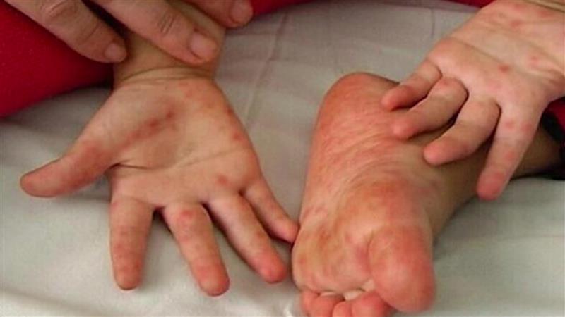 Педијатрите дневно дијагностицират од три до 4 деца со коксаки вирус